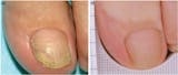 Resultado antes y después tratamiento anti hongos